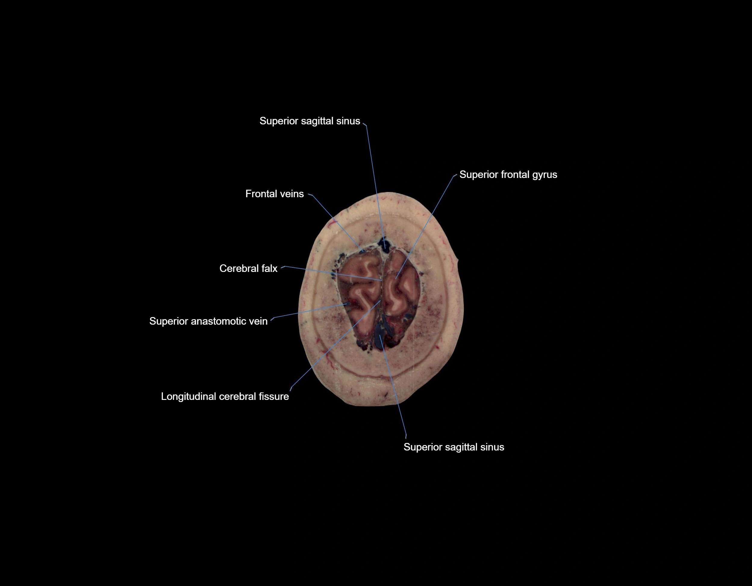 MRI Brain axial cross sectional radiology anatomy 3T image  -img-000074.webp